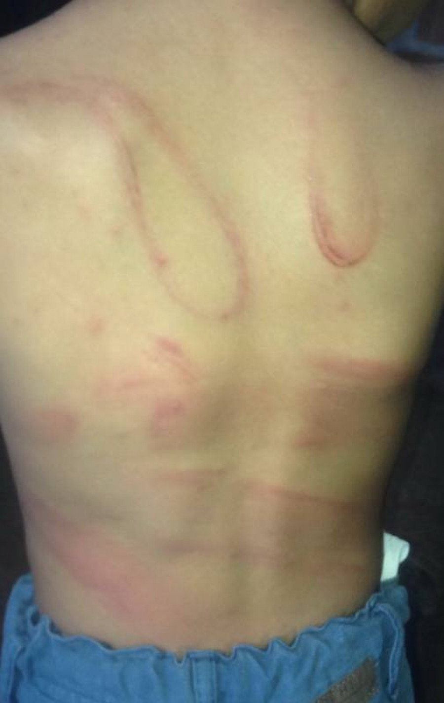 As costas do garoto de apenas 2 anos revelam o horror da violência que ele sofreu (Foto: Divulgação)