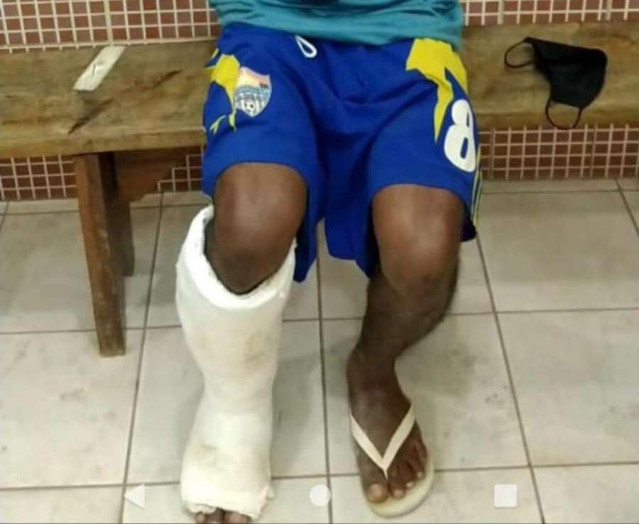 Com falsa fratura na perna, homem foi flagrado tentando ingressar na CPP de Palmas com celulares escondidos em gesso