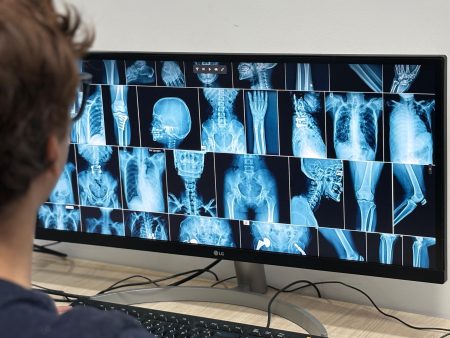 Número de atendimentos a vítimas de acidentes de trânsito faz Prefeitura de Palmas avaliar oferta de ortopedia nas UPAs